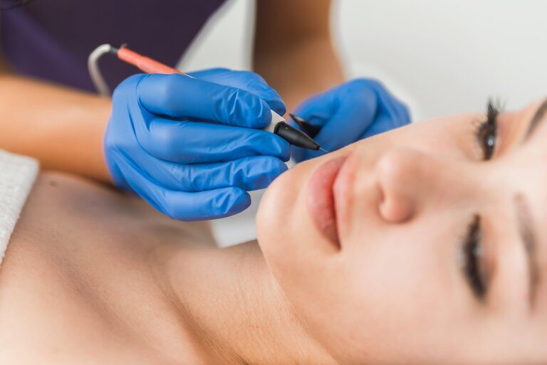 Electrolysis hair removal