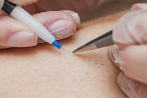 MOON ELECTROLYSIS place picture